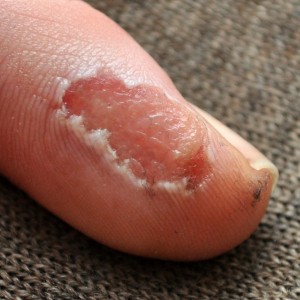 Diese Schürfwunde am Finger wurde erfolgreich mit Honig behandelt.